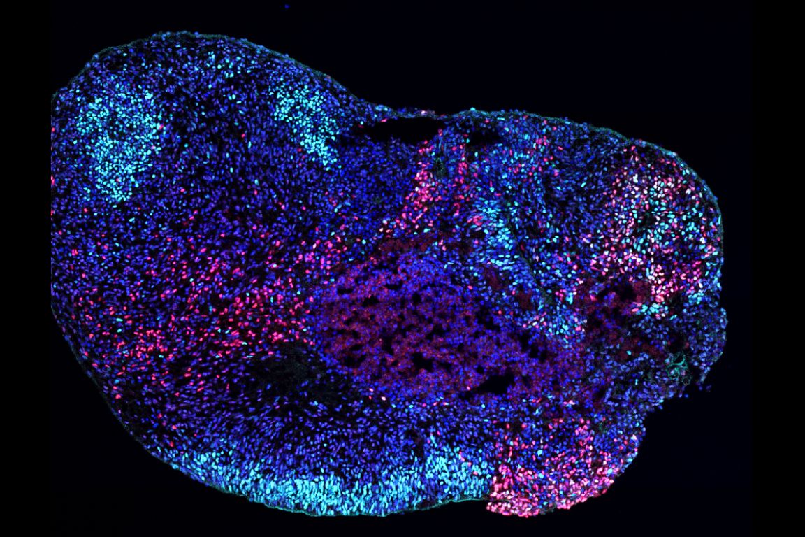 UCLA researchers find how epilepsy genes disrupt different brain